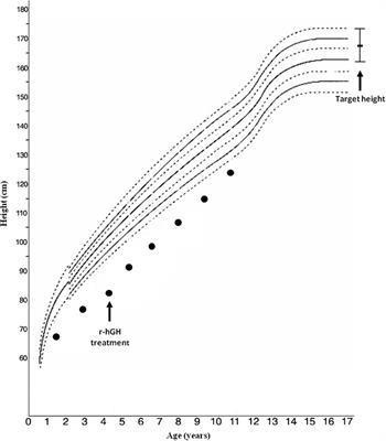 Bone Status in a Patient with Insulin-Like Growth Factor-1 Receptor Deletion Syndrome: Bone Quality and Structure Evaluation Using Dual-Energy X-Ray Absorptiometry, Peripheral Quantitative Computed Tomography, and Quantitative Ultrasonography